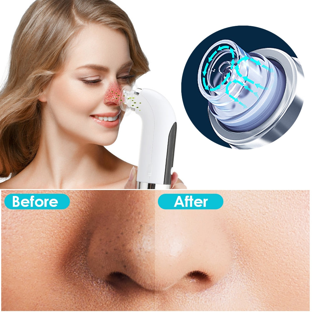 Small Blackhead Remover